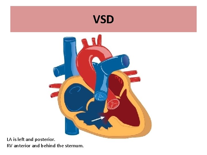 VSD LA is left and posterior. RV anterior and behind the sternum. 