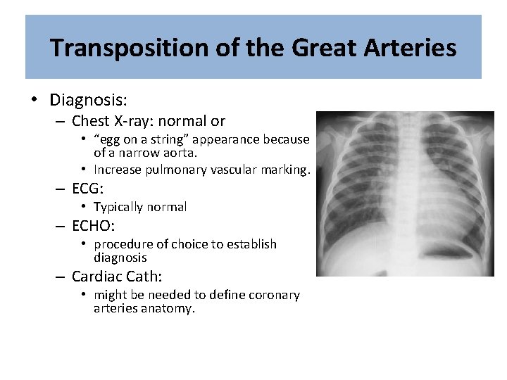 Transposition of the Great Arteries • Diagnosis: – Chest X-ray: normal or • “egg