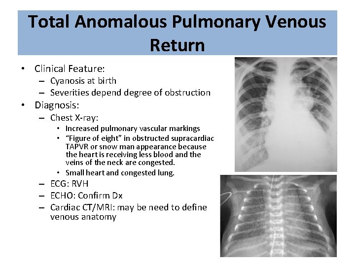 Total Anomalous Pulmonary Venous Return • Clinical Feature: – Cyanosis at birth – Severities