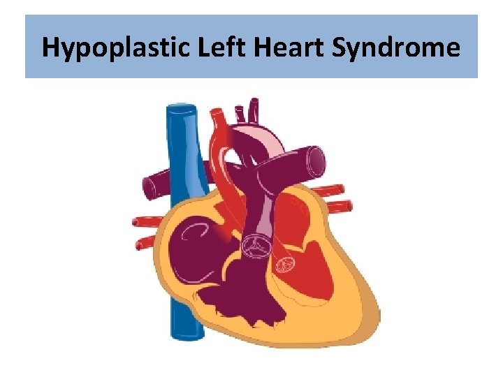 Hypoplastic Left Heart Syndrome 