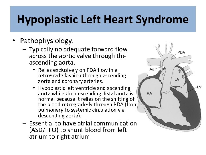 Hypoplastic Left Heart Syndrome • Pathophysiology: – Typically no adequate forward flow across the