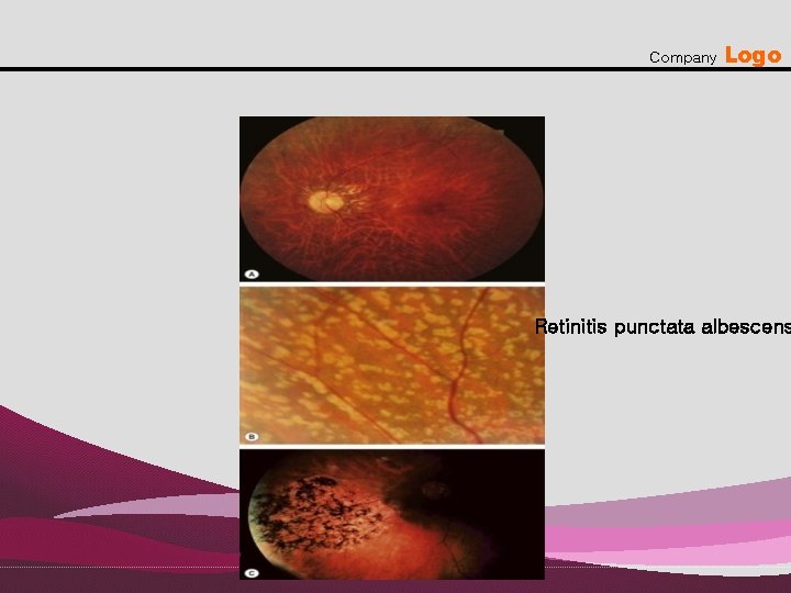 Company Logo Retinitis punctata albescens 