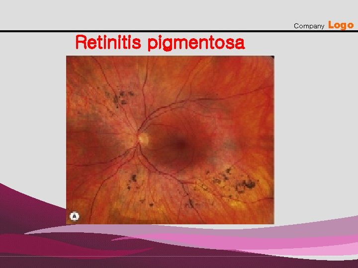 Company Retinitis pigmentosa Logo 