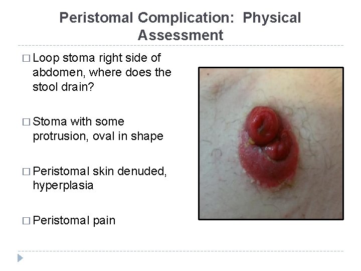 Peristomal Complication: Physical Assessment � Loop stoma right side of abdomen, where does the