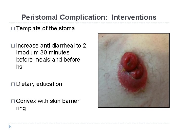 Peristomal Complication: Interventions � Template of the stoma � Increase anti diarrheal to 2