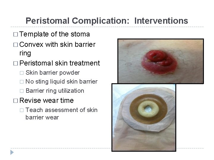 Peristomal Complication: Interventions � Template of the stoma � Convex with skin barrier ring