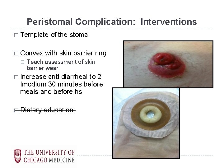 Peristomal Complication: Interventions � Template � Convex � of the stoma with skin barrier