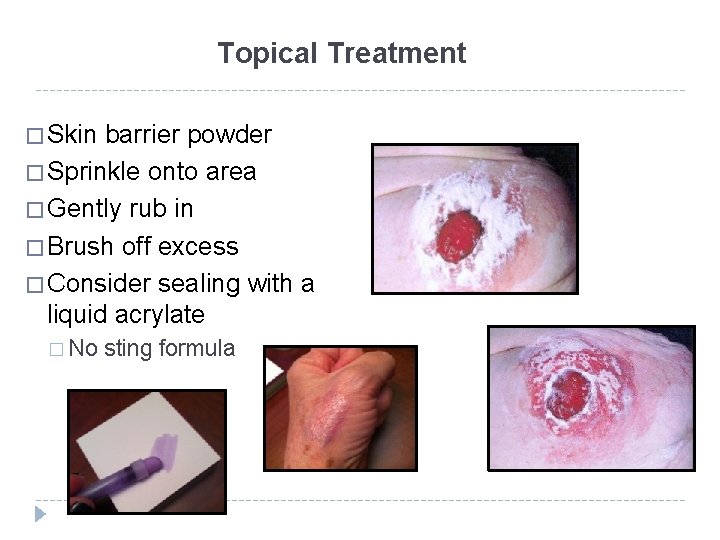 Topical Treatment � Skin barrier powder � Sprinkle onto area � Gently rub in
