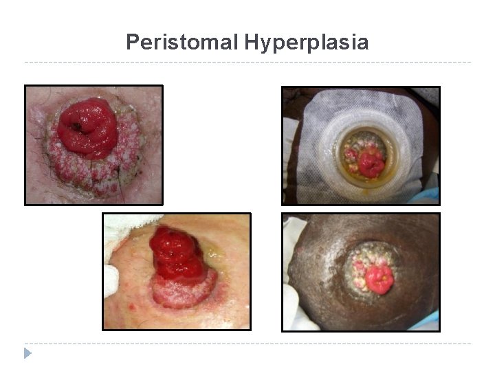 Peristomal Hyperplasia 