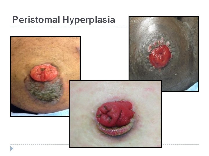Peristomal Hyperplasia 