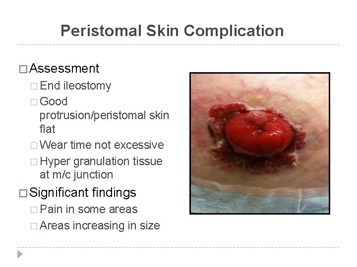 Peristomal Skin Complication � Assessment � End ileostomy � Good protrusion/peristomal skin flat �