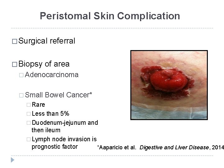 Peristomal Skin Complication � Surgical � Biopsy referral of area � Adenocarcinoma � Small