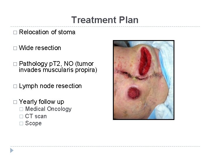 Treatment Plan � Relocation � Wide of stoma resection � Pathology p. T 2,