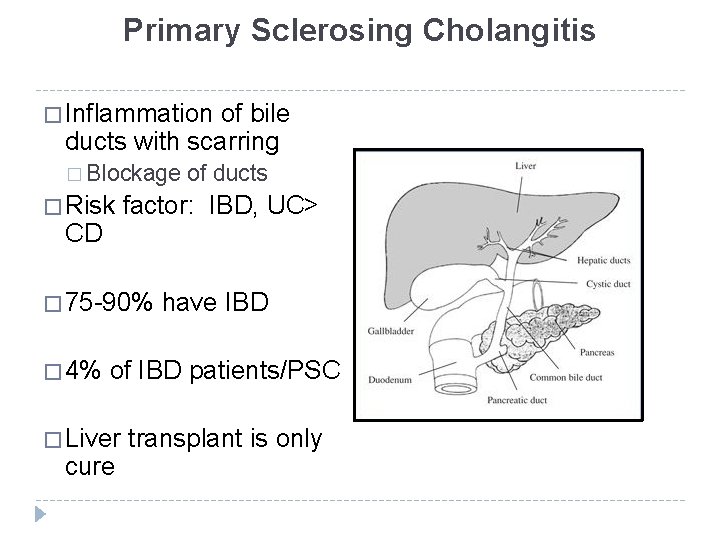 Primary Sclerosing Cholangitis � Inflammation of bile ducts with scarring � Blockage � Risk