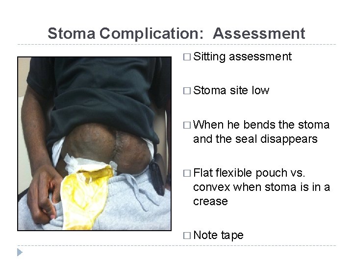 Stoma Complication: Assessment � Sitting assessment � Stoma site low � When he bends