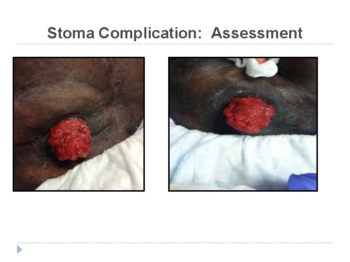 Stoma Complication: Assessment 