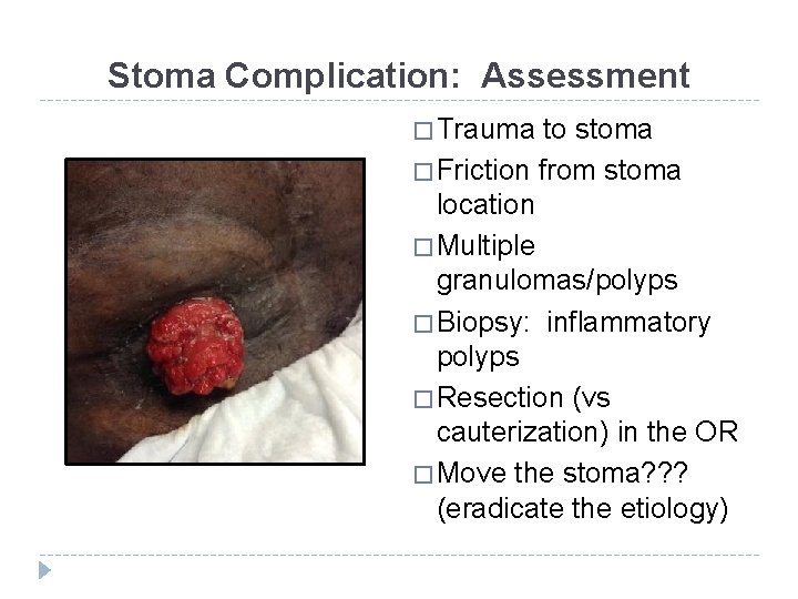 Stoma Complication: Assessment � Trauma to stoma � Friction from stoma location � Multiple
