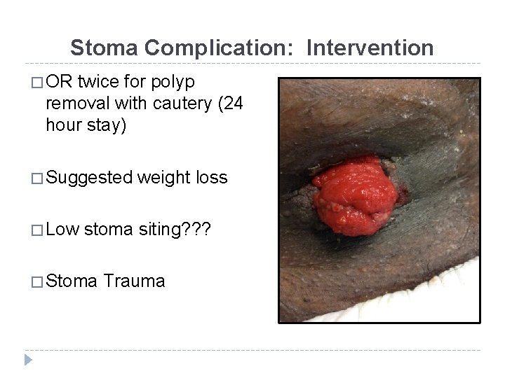 Stoma Complication: Intervention � OR twice for polyp removal with cautery (24 hour stay)