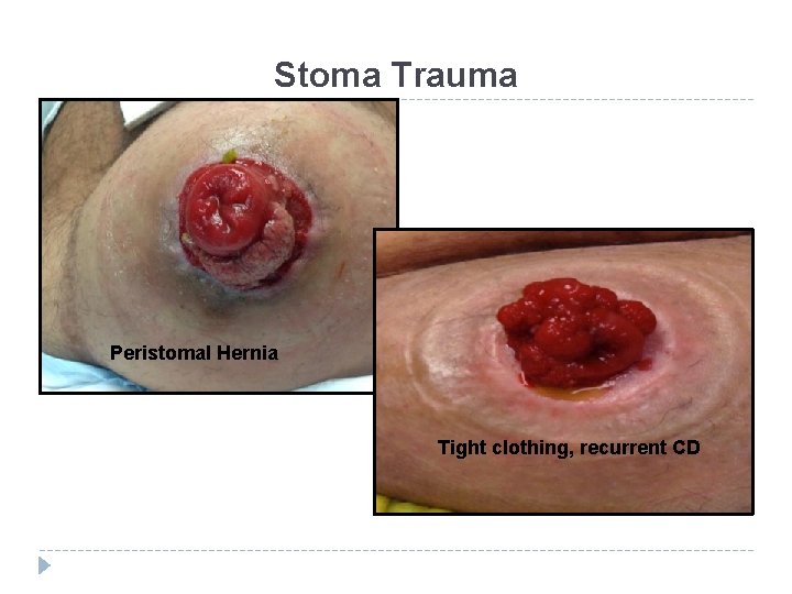 Stoma Trauma Peristomal Hernia Tight clothing, recurrent CD 