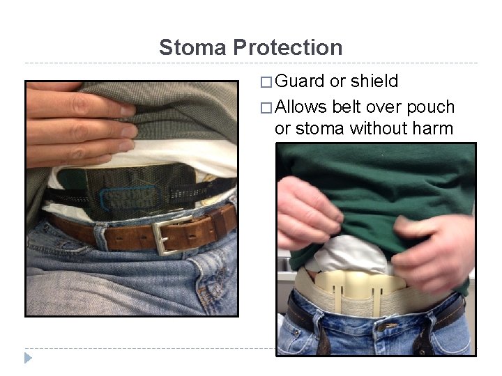 Stoma Protection � Guard or shield � Allows belt over pouch or stoma without