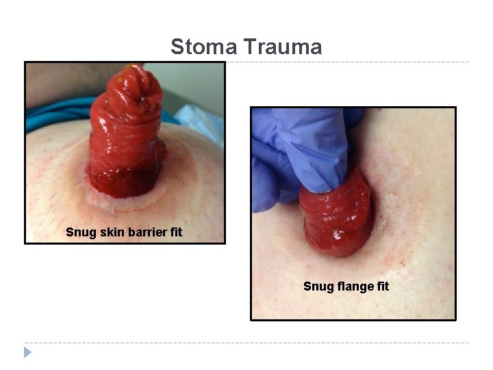 Stoma Trauma Snug skin barrier fit Snug flange fit 