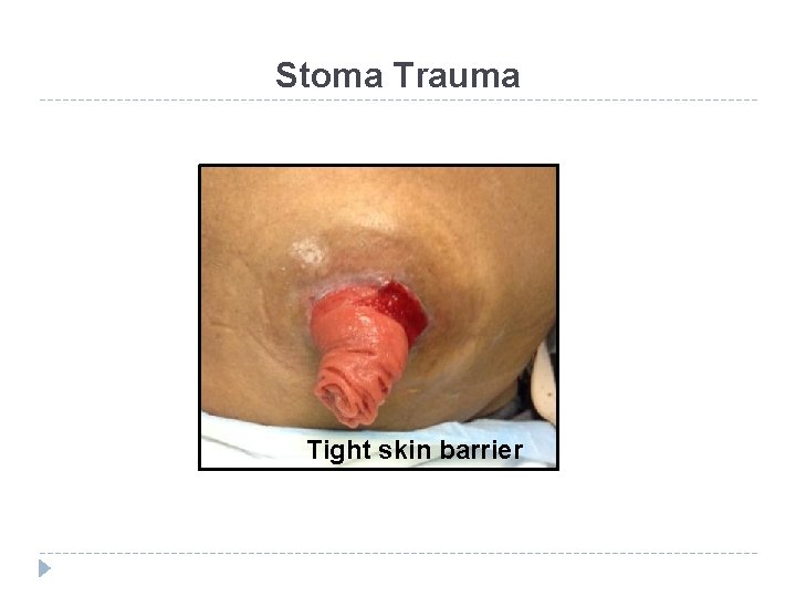 Stoma Trauma Tight skin barrier 
