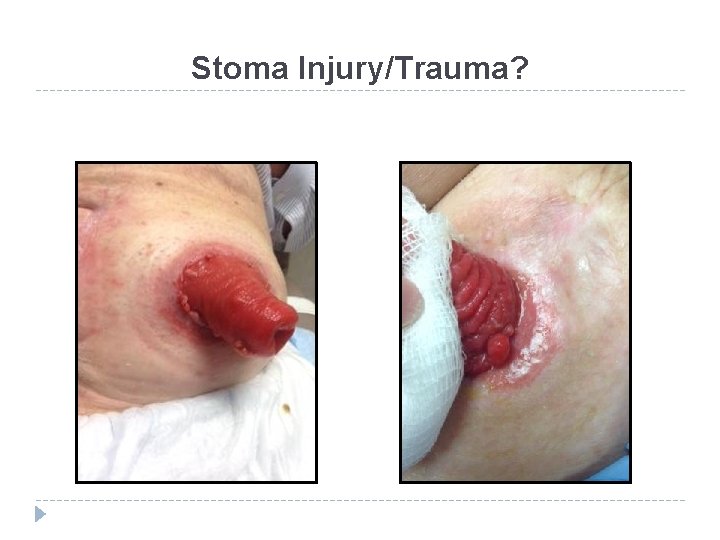 Stoma Injury/Trauma? 