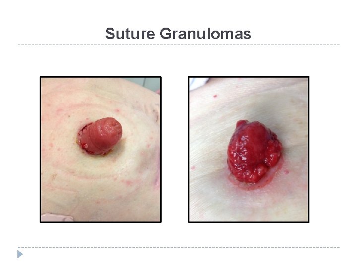 Suture Granulomas 