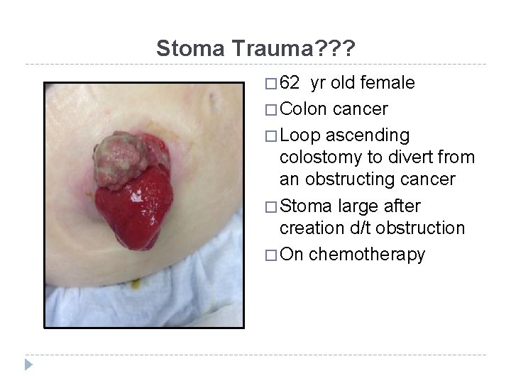 Stoma Trauma? ? ? � 62 yr old female � Colon cancer � Loop
