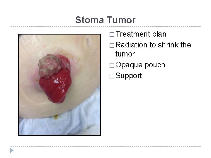 Stoma Tumor � Treatment plan � Radiation to shrink the tumor � Opaque pouch
