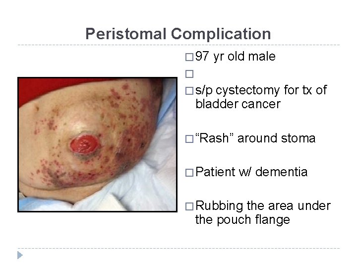 Peristomal Complication � 97 yr old male � � s/p cystectomy for tx of