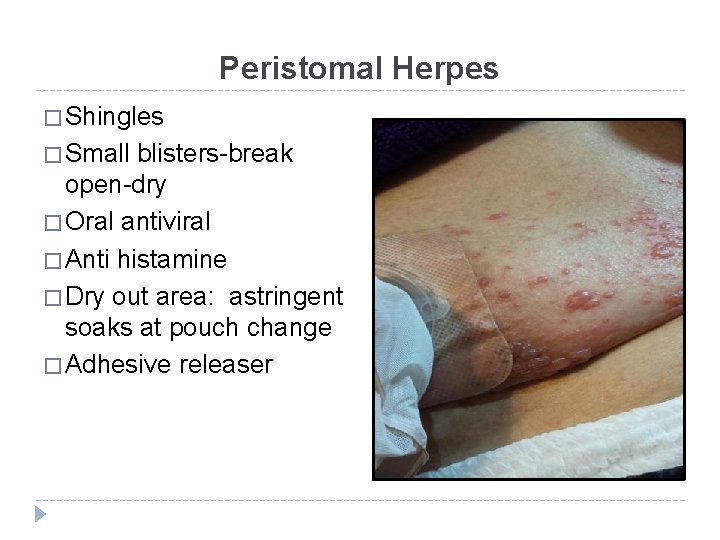 Peristomal Herpes � Shingles � Small blisters-break open-dry � Oral antiviral � Anti histamine