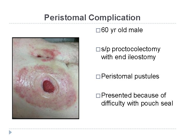 Peristomal Complication � 60 yr old male � s/p proctocolectomy with end ileostomy �