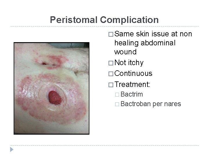Peristomal Complication � Same skin issue at non healing abdominal wound � Not itchy