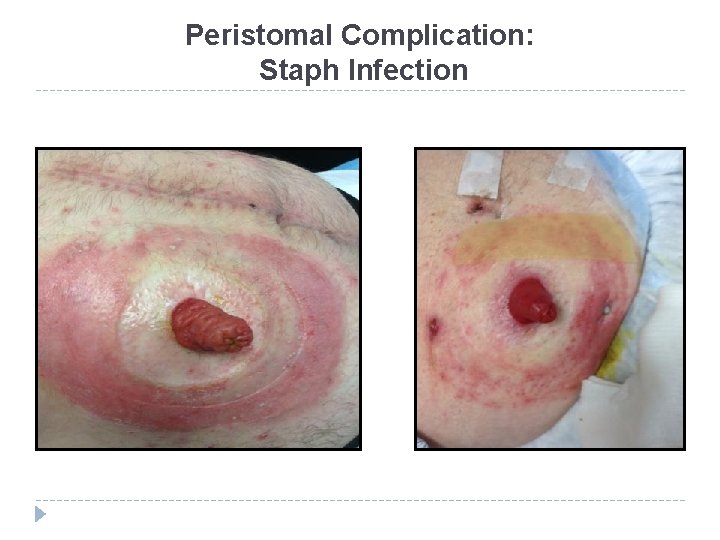 Peristomal Complication: Staph Infection 