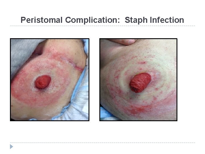 Peristomal Complication: Staph Infection 