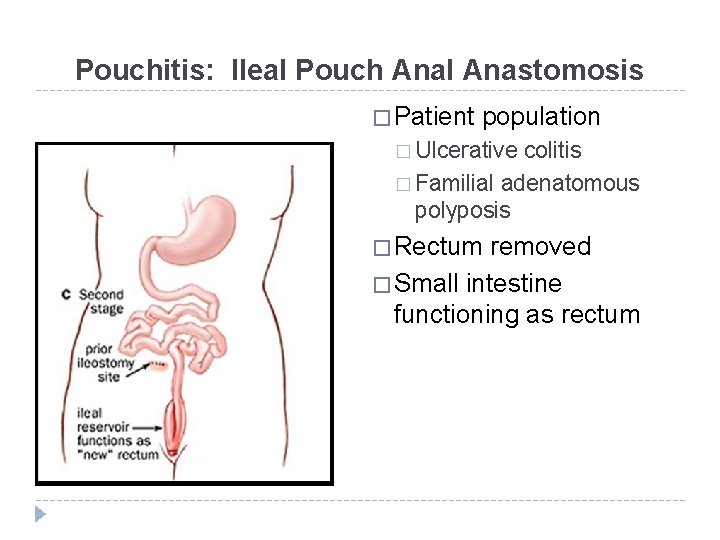 Pouchitis: Ileal Pouch Anal Anastomosis � Patient population � Ulcerative colitis � Familial adenatomous