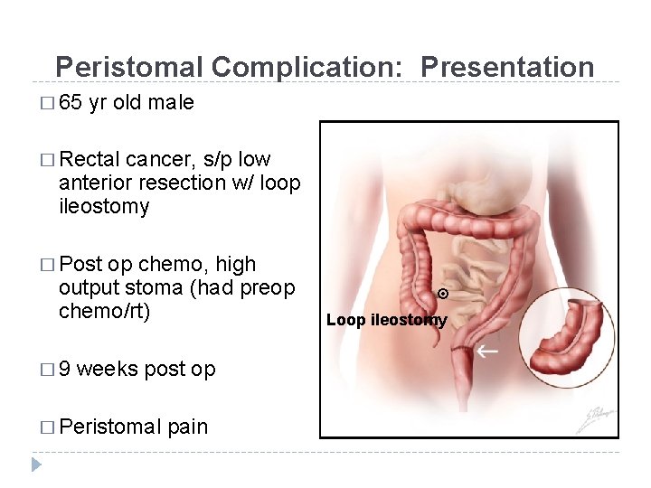 Peristomal Complication: Presentation � 65 yr old male � Rectal cancer, s/p low anterior