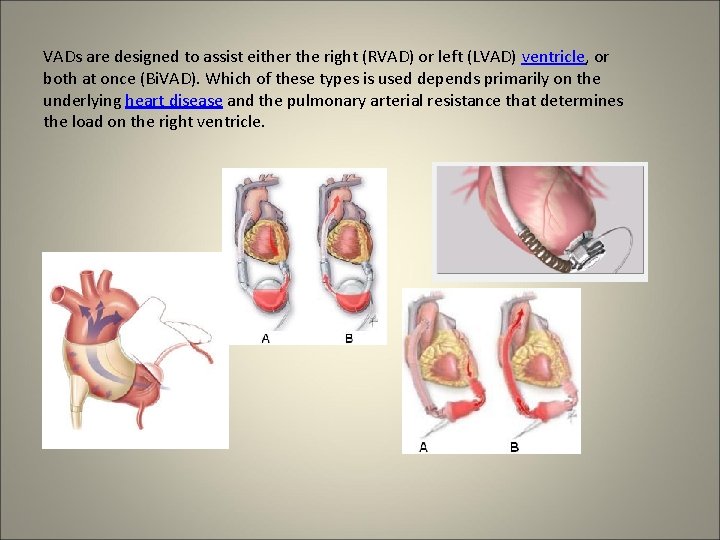 VADs are designed to assist either the right (RVAD) or left (LVAD) ventricle, or