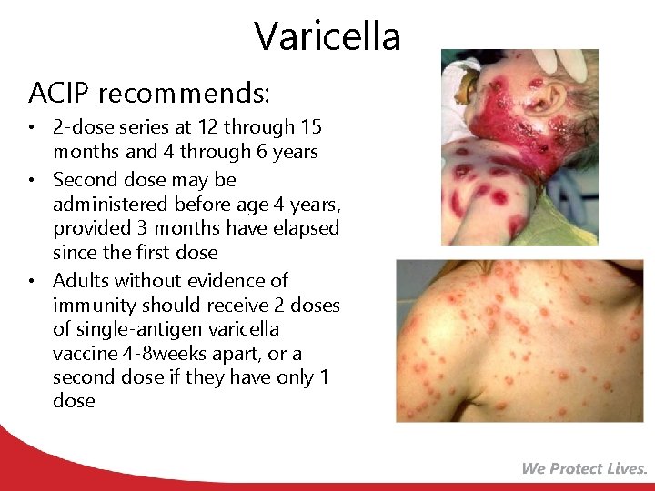 Varicella ACIP recommends: • 2 -dose series at 12 through 15 months and 4