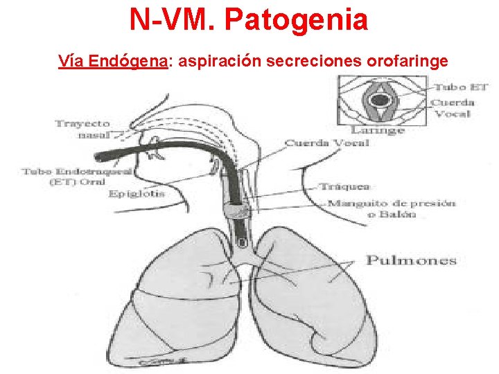 N-VM. Patogenia Vía Endógena: aspiración secreciones orofaringe 