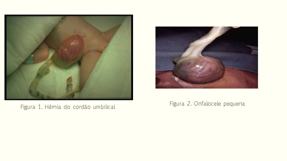 Figura 1. Hérnia do cordão umbilical Figura 2. Onfalocele pequena 
