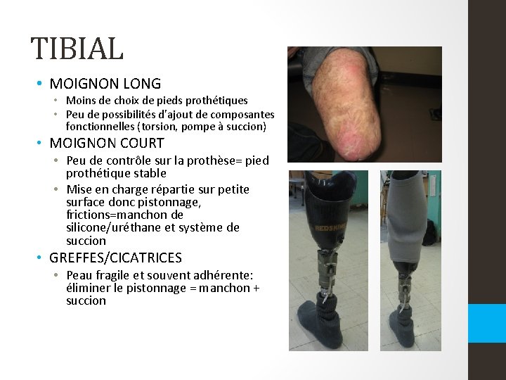 TIBIAL • MOIGNON LONG • Moins de choix de pieds prothétiques • Peu de TIBIAL • MOIGNON LONG • Moins de choix de pieds prothétiques • Peu de