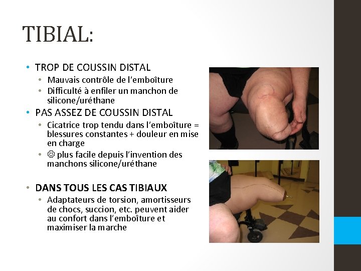 TIBIAL: • TROP DE COUSSIN DISTAL • Mauvais contrôle de l’emboîture • Difficulté à TIBIAL: • TROP DE COUSSIN DISTAL • Mauvais contrôle de l’emboîture • Difficulté à