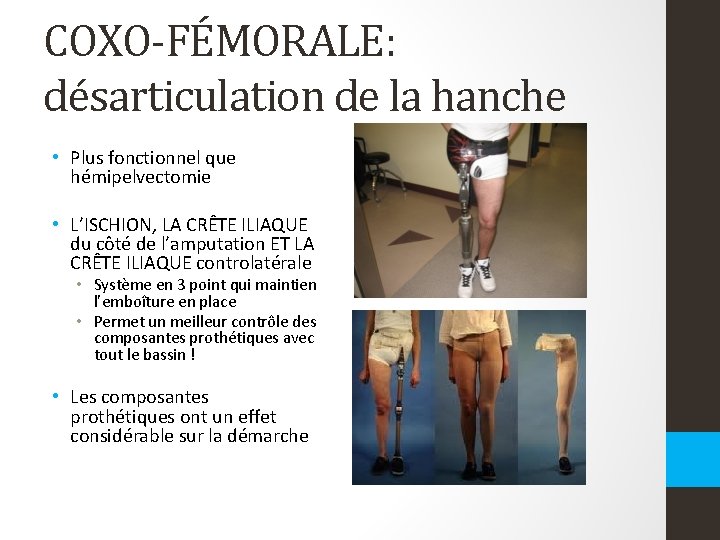 COXO-FÉMORALE: désarticulation de la hanche • Plus fonctionnel que hémipelvectomie • L’ISCHION, LA CRÊTE COXO-FÉMORALE: désarticulation de la hanche • Plus fonctionnel que hémipelvectomie • L’ISCHION, LA CRÊTE