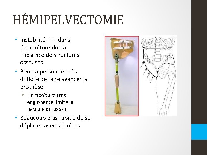 HÉMIPELVECTOMIE • Instabilité +++ dans l’emboîture due à l’absence de structures osseuses • Pour HÉMIPELVECTOMIE • Instabilité +++ dans l’emboîture due à l’absence de structures osseuses • Pour