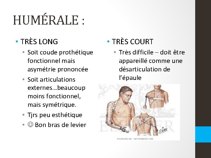 HUMÉRALE : • TRÈS LONG • Soit coude prothétique fonctionnel mais asymétrie prononcée • HUMÉRALE : • TRÈS LONG • Soit coude prothétique fonctionnel mais asymétrie prononcée •