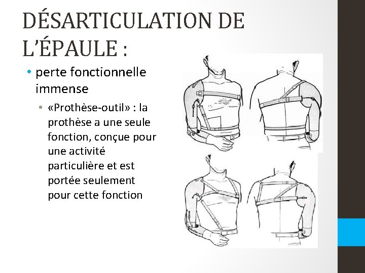 DÉSARTICULATION DE L’ÉPAULE : • perte fonctionnelle immense • «Prothèse-outil» : la prothèse a DÉSARTICULATION DE L’ÉPAULE : • perte fonctionnelle immense • «Prothèse-outil» : la prothèse a