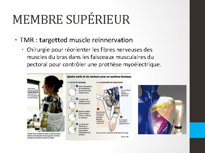 MEMBRE SUPÉRIEUR • TMR : targetted muscle reinnervation • Chirurgie pour réorienter les fibres MEMBRE SUPÉRIEUR • TMR : targetted muscle reinnervation • Chirurgie pour réorienter les fibres