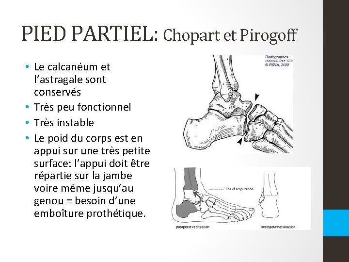 PIED PARTIEL: Chopart et Pirogoff • Le calcanéum et l’astragale sont conservés • Très PIED PARTIEL: Chopart et Pirogoff • Le calcanéum et l’astragale sont conservés • Très